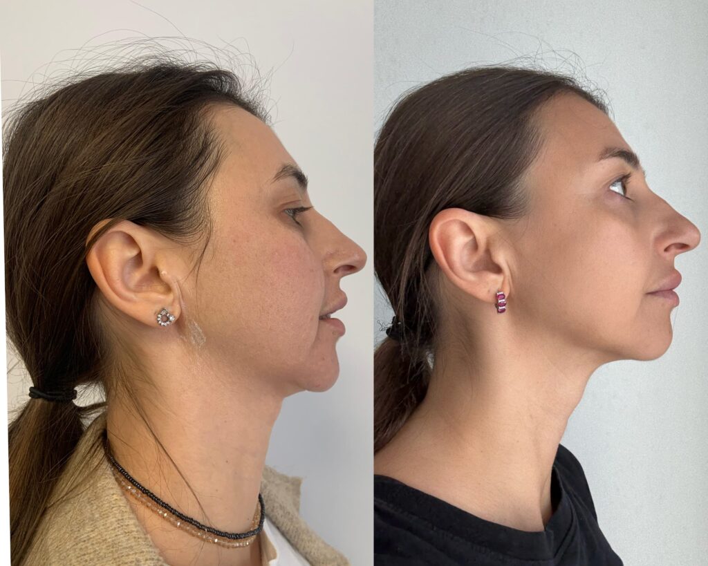 Contur Mandibular